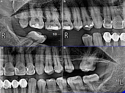 Insights Diagnostic CBCT Scan Services Bitewing